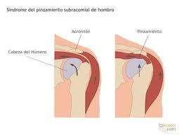 Pinzamiento Hombro