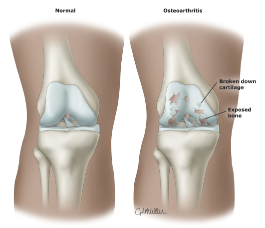 Osteoarthritis-PI