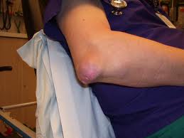 bursitis olecraniana