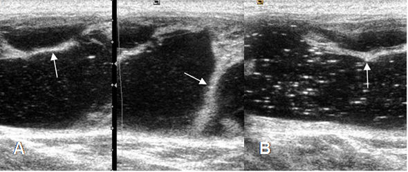 Ecografía quiste de Baker 1