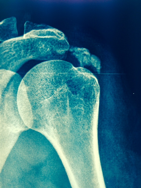 Tendinitis calcificante del supraespinoso