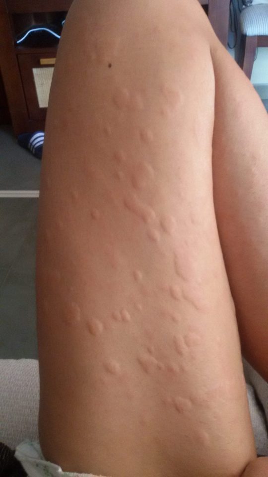 Vasculitis Urticariforme