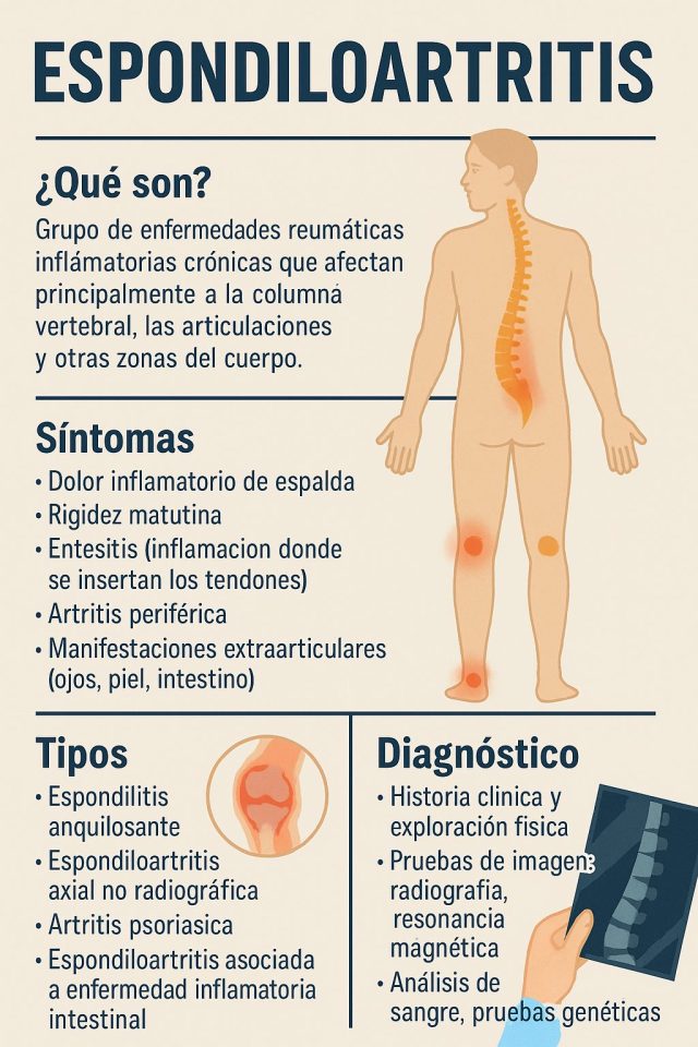 “Espondiloartritis: síntomas, tipos y diagnóstico explicado por un reumatólogo”